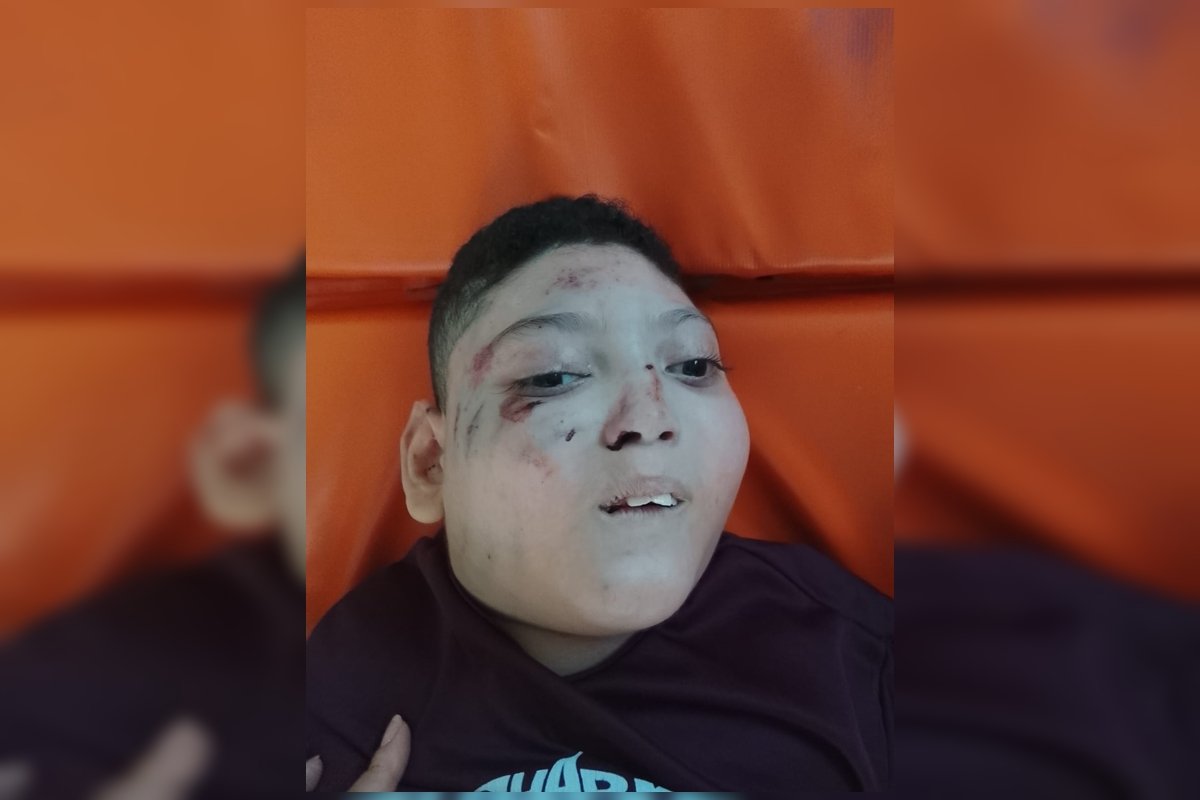 Criança cadeirante sofre queda em escada rolante no Metrô-DF e é internada na UTI